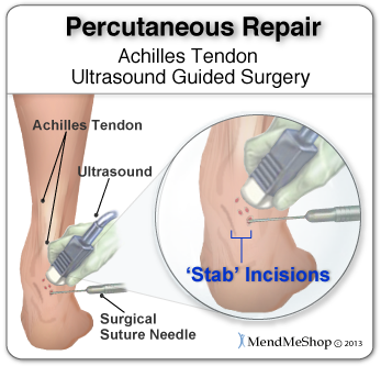 Steroid injection for tendonitis in foot